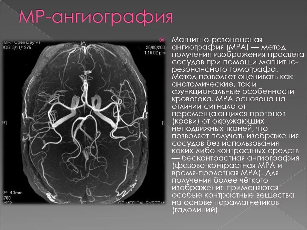 Венография головного мозга. Мрт ангиография сосудов головного мозга. Мрт головного мозга с ангиографией. Мрт ангиография артерий головного мозга. Магнитно-резонансная венография головного мозга.