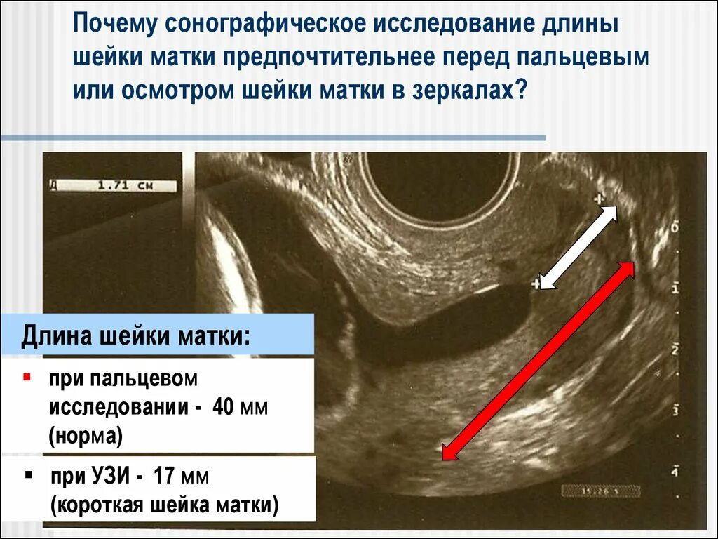Нормальная матка на УЗИ. Шейка по срокам беременности. Наружный и внутренний зев матки. Беременность шейка 3
