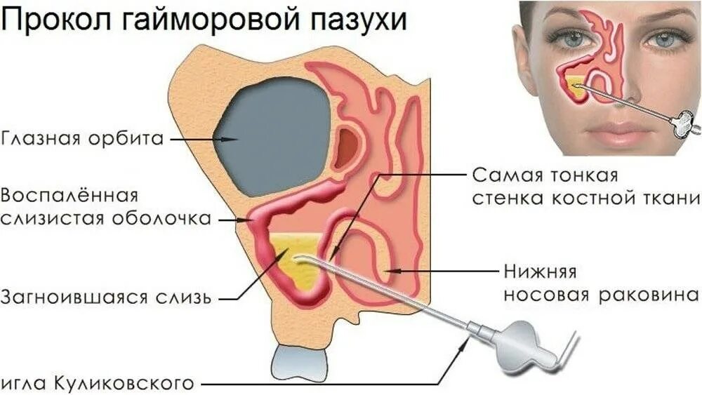 После прокола гайморовой. Диагностическая пункция гайморовой пазухи. Гайморит прокол гайморовой пазухи. Протокол операции пункция гайморовой пазухи. Пункция верхнечелюстной пазухи носа.