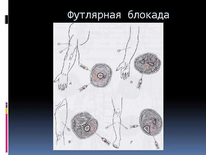 Блокада предплечья. Футлярная блокада по вишневскому техника. футлярная блокада конечностей. футлярная блокада плеча показания. футлярная новокаиновая блокада показания.