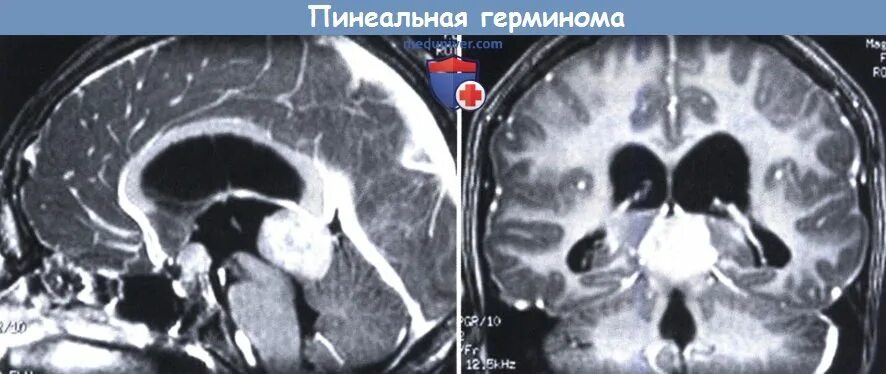 Герминома шишковидной железы кт. Киста пинеальной области на мрт. Опухоли пинеальной области мрт. Пинеалома опухоль шишковидной железы. Герминома