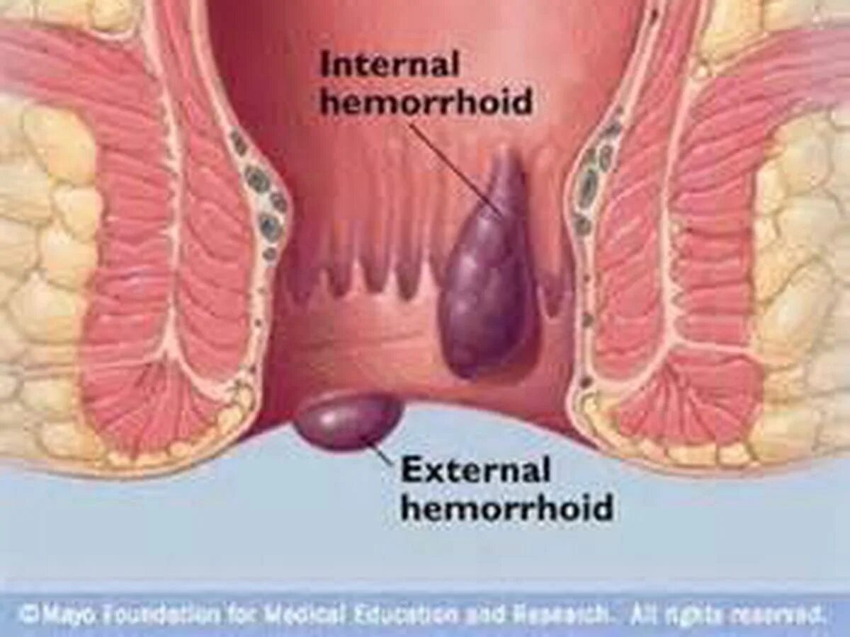 Трещина болит. Внешний геморроидальный узел. Геморроидальный узел снаружи. Внутренний и внешний геморрой.