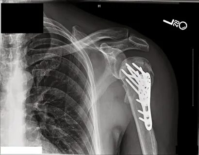 Fracture well