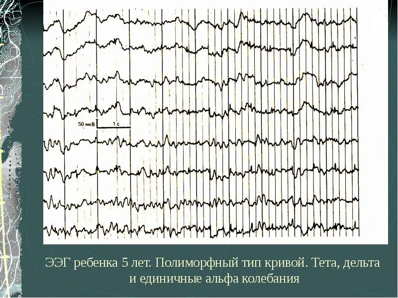 Ээг асимметрия. Дельта волны на ээг. ээг при болезни крейтцфельдта-якоба. ээг ребенка 5 лет.