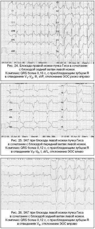 Блокада левой задней ножки. Блокада задней ветви ЛНПГ на ЭКГ. Вектор ЭОС при блокаде левой ножки пучка Гиса. Блокада задней ветви левой ножки. Блокада задней ветви левой ножки пучка Гиса на ЭКГ.