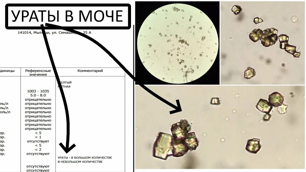 Аморфные Ураты микроскопия мочи. Оксалаты уротраты в моче. Оксалаты фосфаты Ураты в моче. Ураты в моче микроскопия. Кристаллы оксалата в моче у мужчин