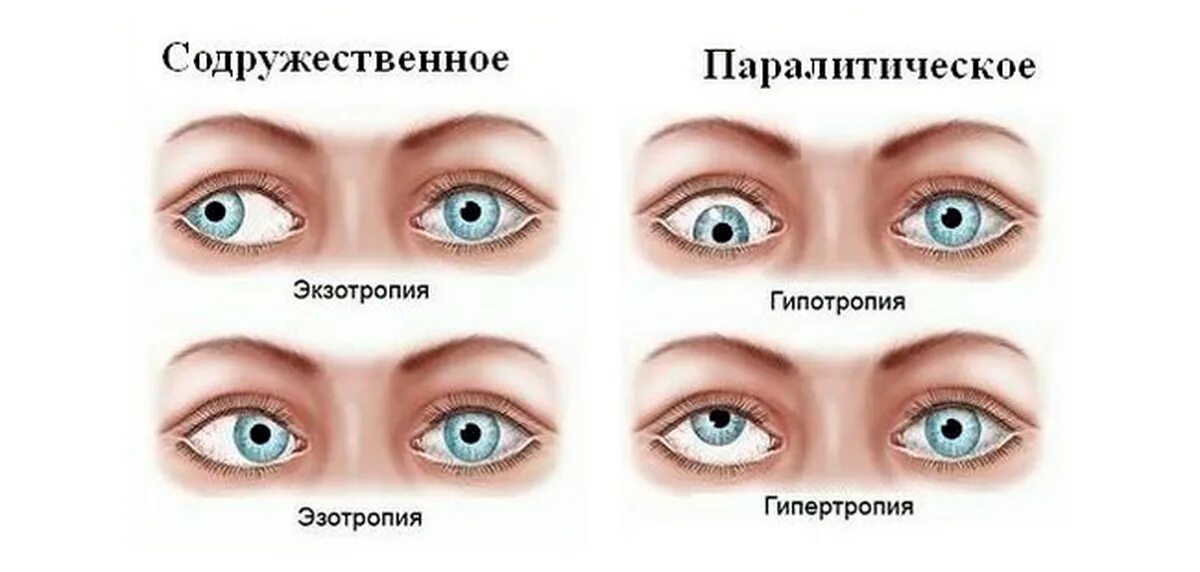 Содружественное и паралитическое косоглазие. Виды косоглазия содружественное и паралитическое. Сходящееся косоглазие. Паралитическое косоглазие. Какой глаз левый а какой правый