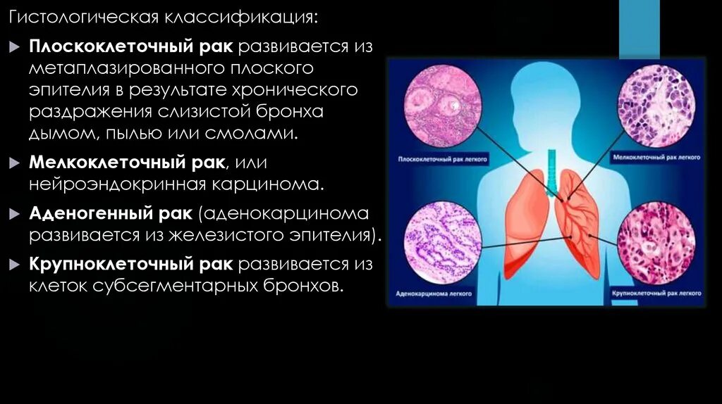 Плоскоклеточная карцинома бронха. Мелкоклеточная карцинома легкого. Мелкоклеточная карцинома легкого гистология. Плоскоклеточныйкласификация. Стадии рака легких плоскоклеточный