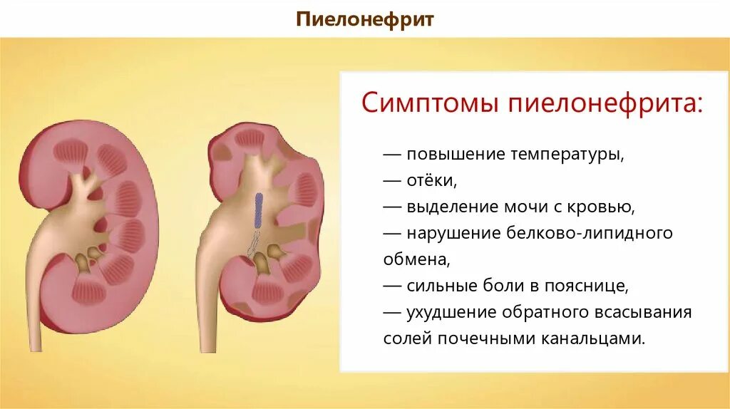 Причины заболевания почек биология. Заболевания выделительной системы. Заболевания органов мочевыделительной системы. Заболевания мочевыделительной системы пиелонефрит. Заболевания выделительной системы и их профилактика.