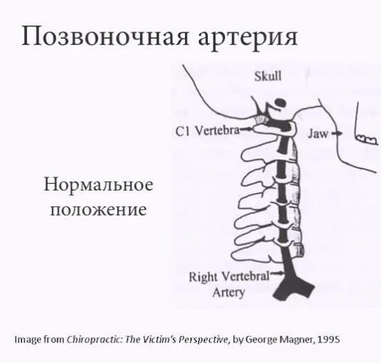 Сегмент v1 v2 позвоночной артерии. V5 сегмент позвоночной артерии. Сегмент v1 позвоночной артерии. Позвоночная артерия сегменты анатомия.