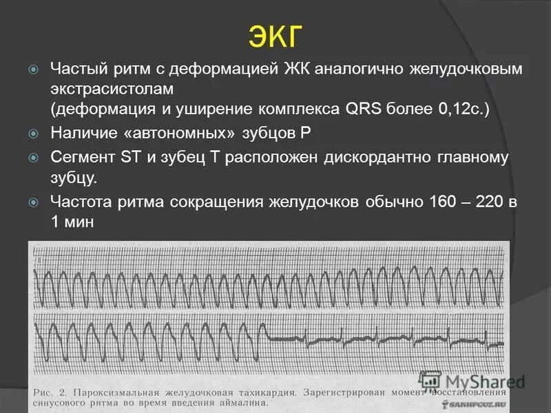 Типы желудочковых экстрасистол