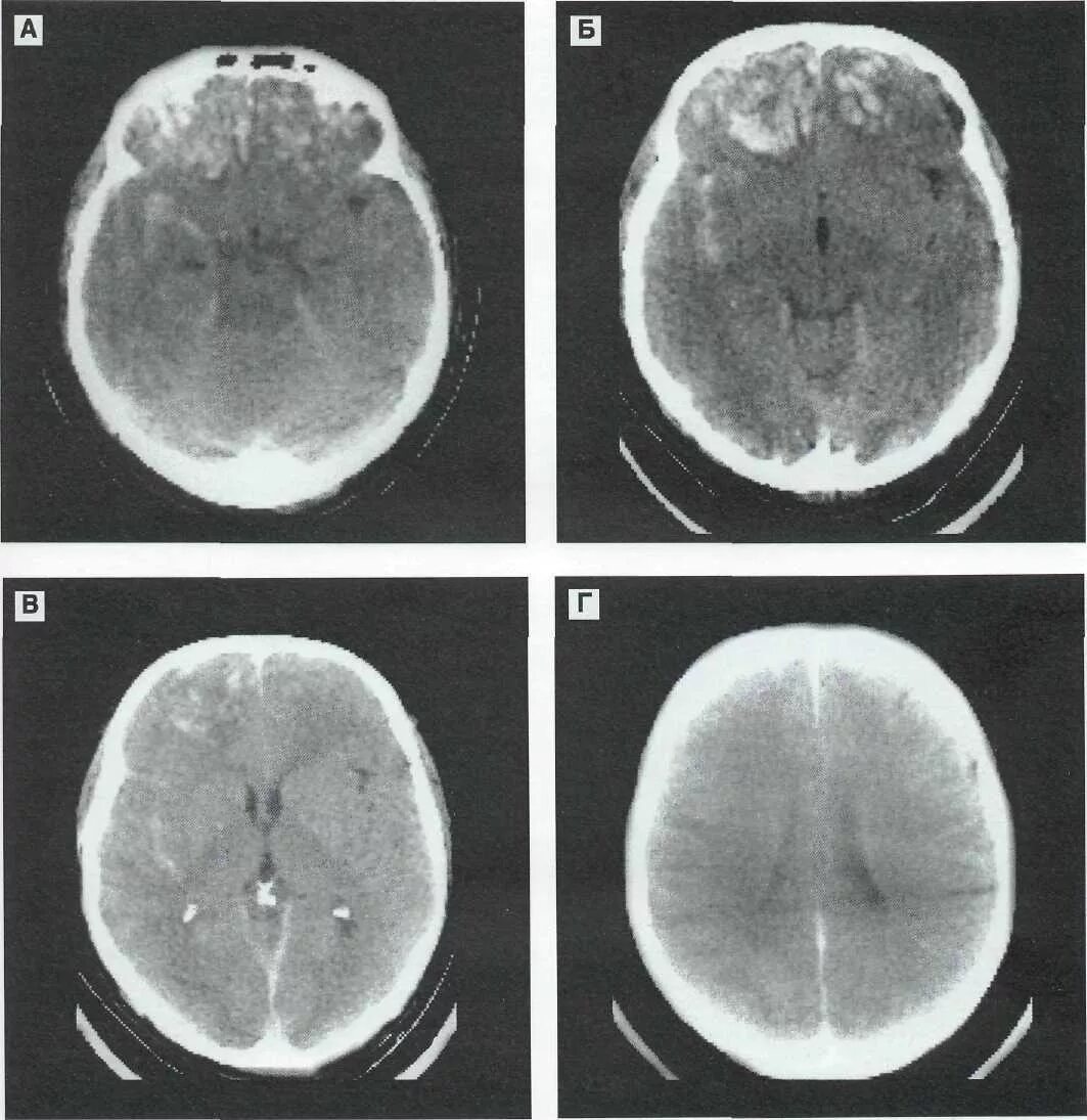 Очаг глиоза в теменной доле. Перелом затылочной кости кт. Контузионный очаг в головном мозге мрт. Сотрясение мозга мрт кт. Контузионный очаг в головном мозге на кт.