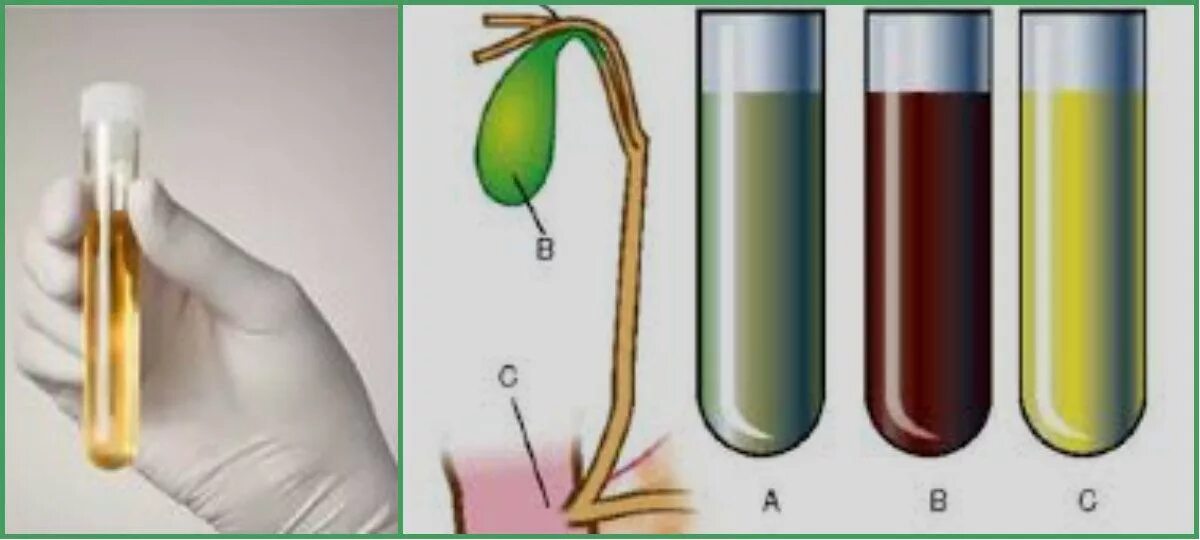 Желчь человека цвет. Многомоментное фракционное дуоденальное зондирование. Фракционное дуоденальное зондирование желчного пузыря. Зондирование желчного пузыря пробирки. Исследование дуоденального зондирования цвет желчи.