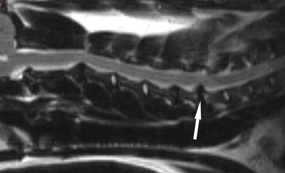 Грыжа межпозвоночного диска у собаки. Протрузия на рентгене. Межпозвоночная грыжа у собак рентген. Грыжа экструзия протрузия у собак. Экструзия дисков шейного отдела позвоночника