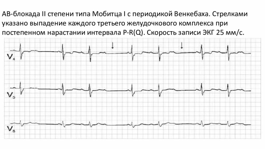 Са блокада 2 тип. Атриовентрикулярная блокада II степени (Тип i Мобитца). Периоды Самойлова-Венкебаха на ЭКГ. АВ блокада 2 степени Мобитц 1 на ЭКГ. Са блокада с периодикой Самойлова Венкебаха на ЭКГ.