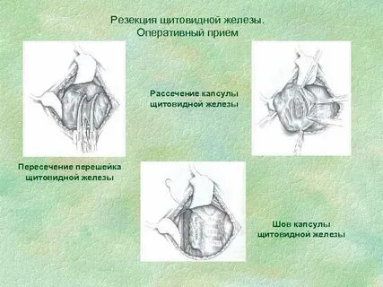 Удаление перешейка щитовидной железы