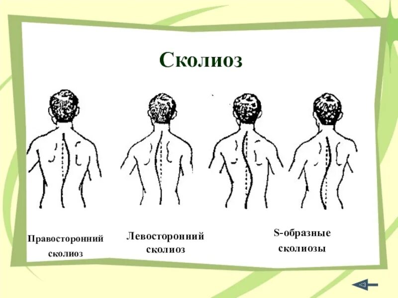 Отдел вправо. Правосторонний сколиоз грудного отдела позвоночника. S образный сколиоз 2 степени грудного отдела. Правосторонний шейно грудной сколиоз. Правосторонний сколиоз 1 степени поясничного отдела позвоночника.
