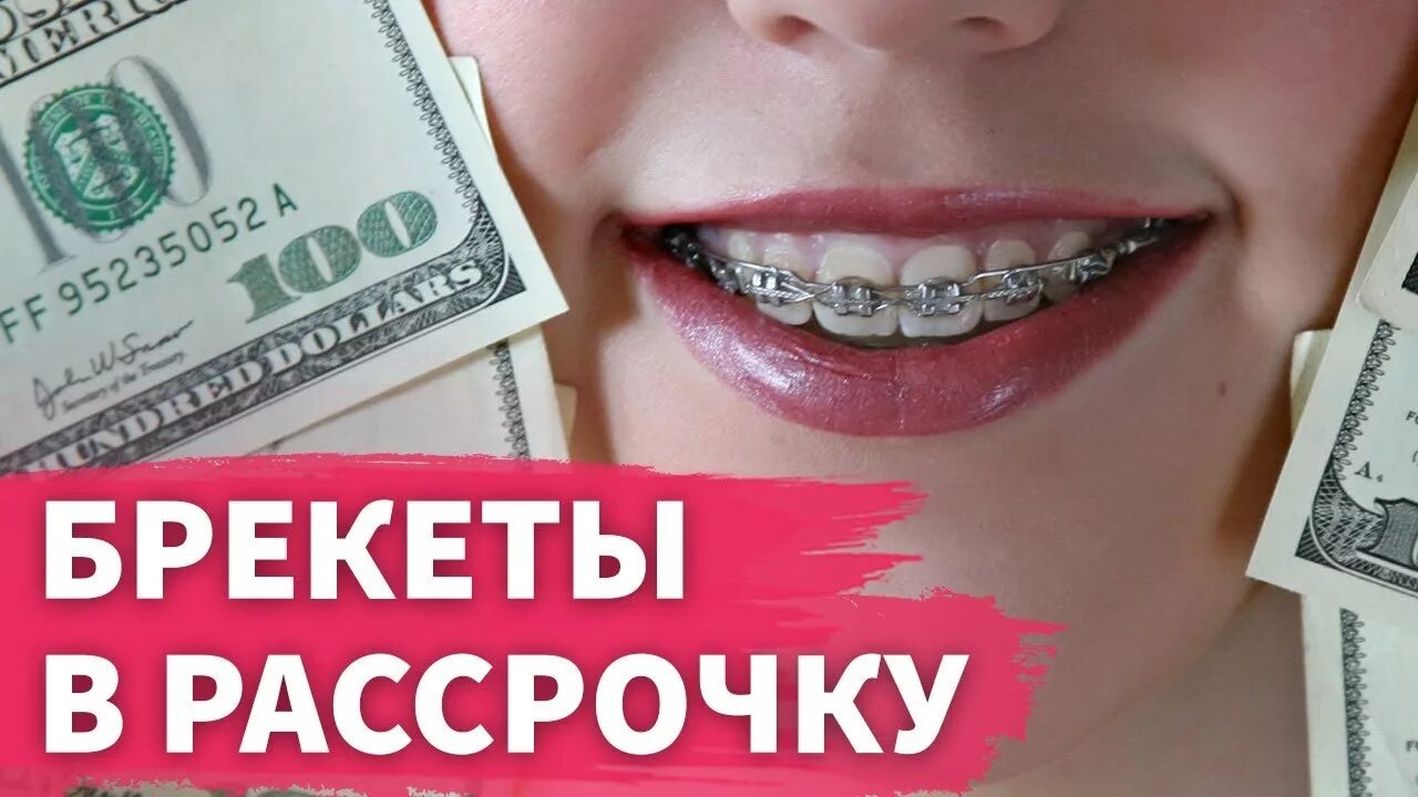 Где сделать зубы в рассрочку. Брекет система рассрочка. брекеты в рассрочку реклама. брекеты в грозном в рассрочку.