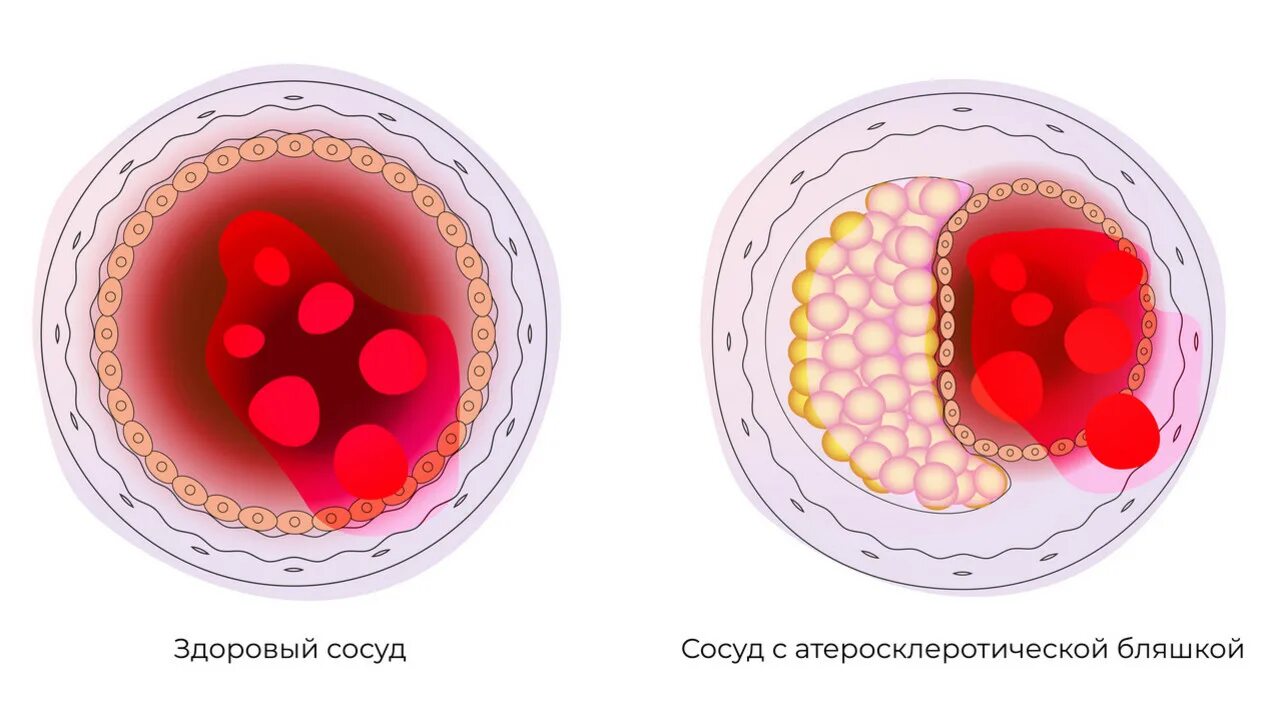 Чем чистить холестериновые бляшки. Атеросклеротическая бляшка.