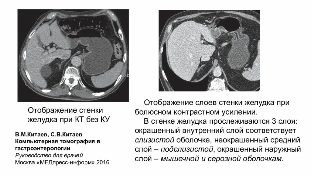 Кт органов брюшной полости опухоль желудка. Контрастирование желудка на кт. Показания для кт при патологии органов ЖКТ:. Опухоли брюшной полости на кт. Язва кт