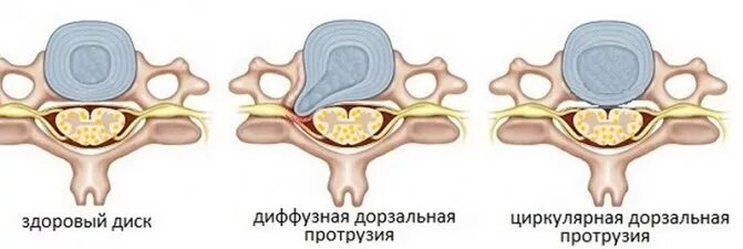 Дорзальная протрузия диска с3-с4. Протрузия диска с3 с4 шейного отдела позвоночника. Протрузия дисков позвоночника с3-с4, с5-с6. Экструзия с5-с6 диска. Протрузия с3-с4 диска.. Экструзия дисков шейного отдела позвоночника
