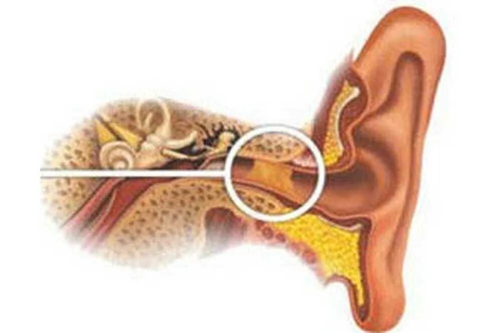 Почему возникает пробка в ухе