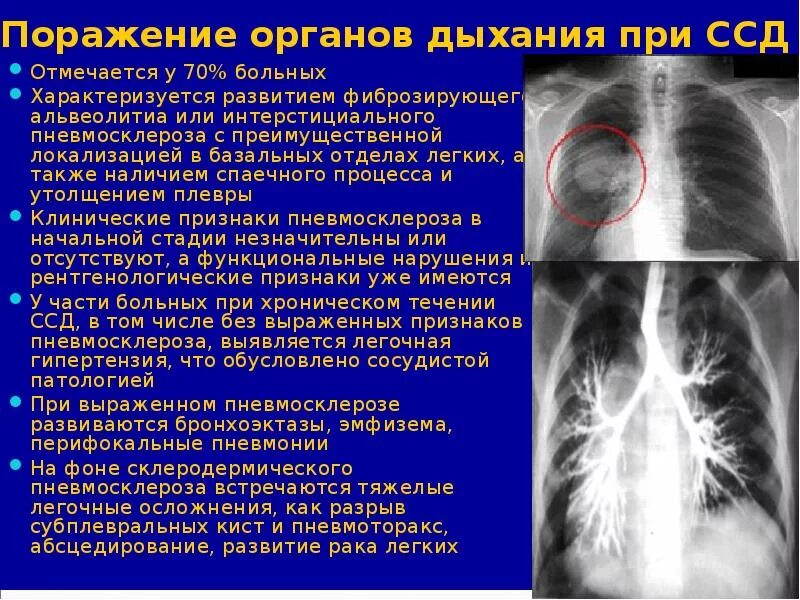 Пневмосклеротические изменения что это