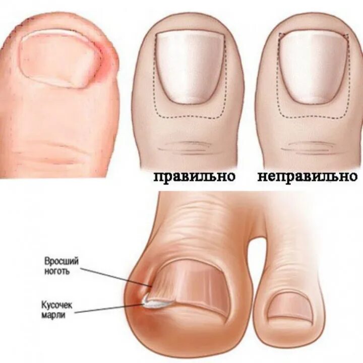Отзыв о Операция по удалению вросшего ногтя на ноге Ужасно, врагу не пожелаю