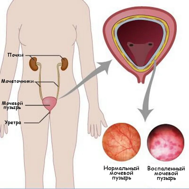Цистит у мужчин симптомы и лечение. Воспаленный мочевой пузырь. Цистит у женщин. Цистит воспаление мочевого пузыря.