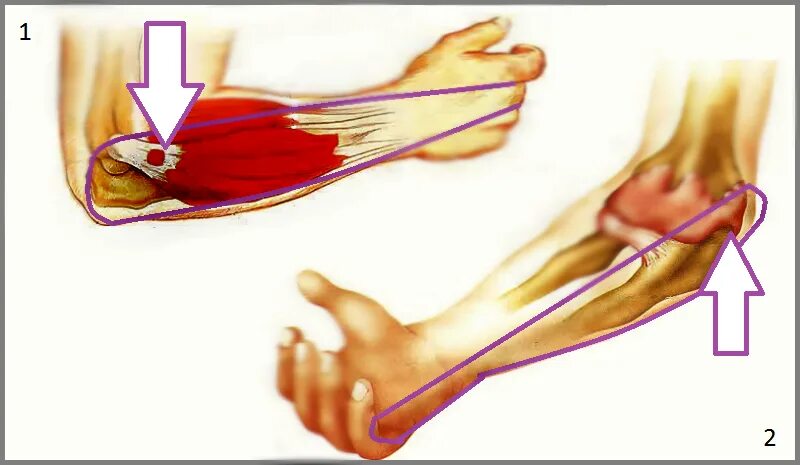 Локтевой сустав мышцы и сухожилия. Эпикондилит локтевого сустава симптомы. Латеральный эпикондилит сухожилие. Латеральный эпикондилит локтевого. Латеральный эпикондилит локтевого сустава.