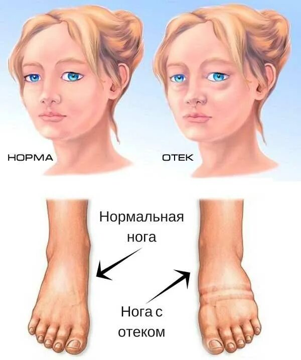 Отечность лица и конечностей. Почему тело мягкое