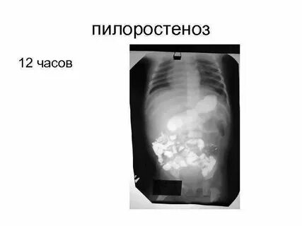 Пилоростеноз это