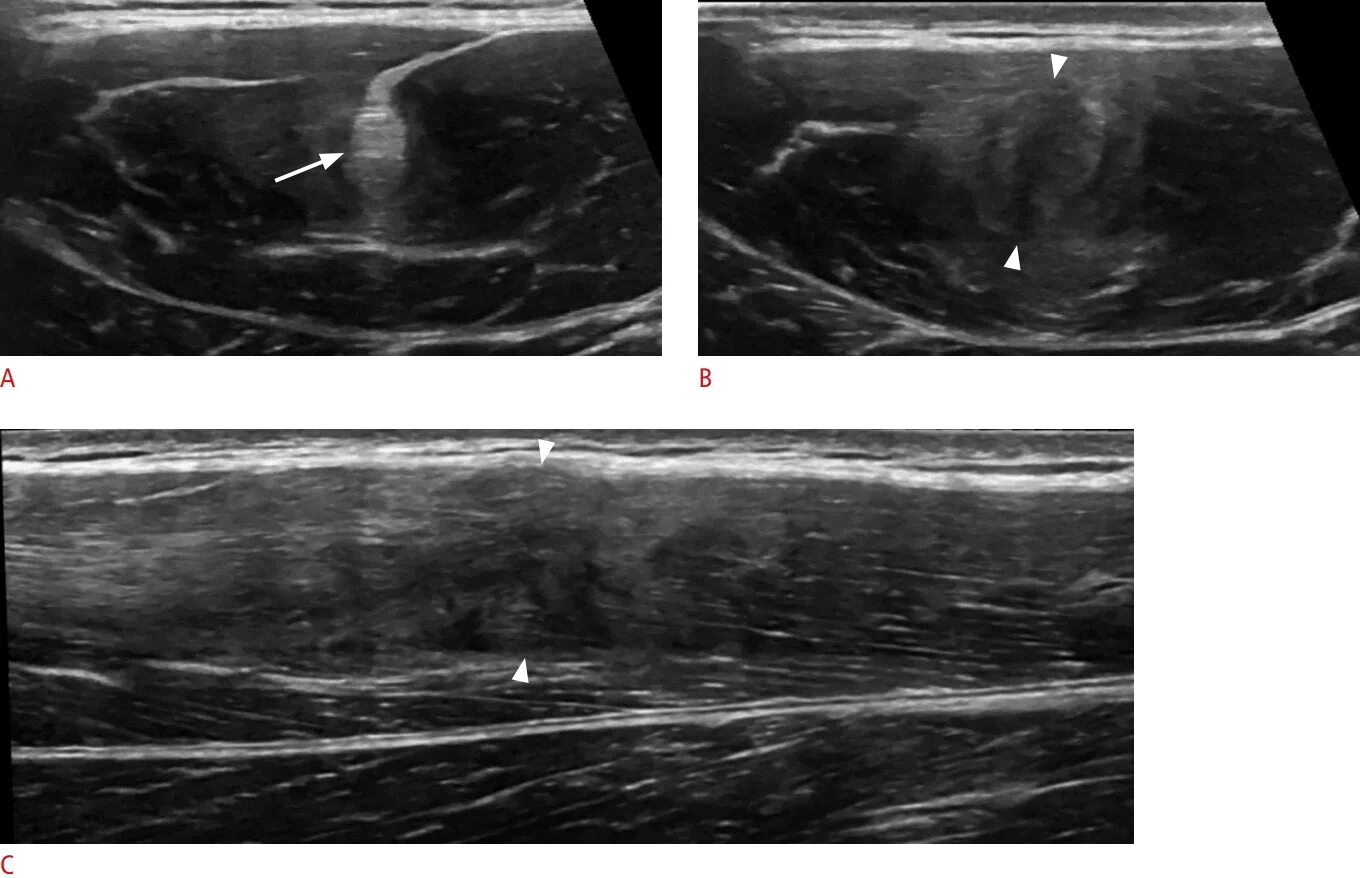 Узи мышц что показывает. Узи мышц что показывает. Узи мягких тканей бедра. Узи мягких тканей (1 анатомическая зона). Узи кивательной мышцы протокол.