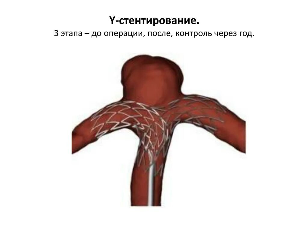 Аневризма стент. Стентирование артерий головного мозга. Стент аневризмы головного мозга. Стент для сосудов головного мозга. Стент сосудов при аневризме головного.