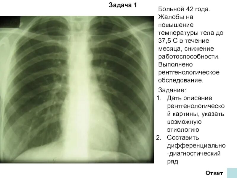 Затемнение верхней доли легкого. Инфильтративный туберкулез бронхолобулярный инфильтрат. Затемнение средней интенсивности с нечеткими контурами. Затемнение с нечеткими контурами в легких. Рентген затемнение доли легкого.