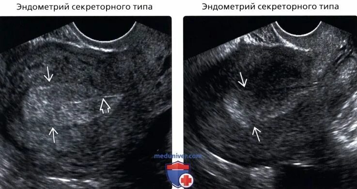 Эндометрия 16 мм