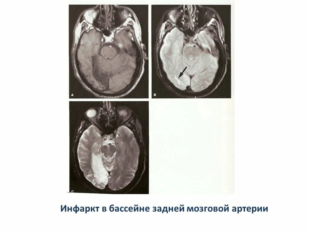 Инсульт в бассейне мозговой артерии. Инфаркт в бассейне передней мозговой артерии. ОНМК В бассейне задней мозговой артерии кт. Инфаркт в бассейне задней мозговой артерии. Инфаркт задней мозговой артерии.