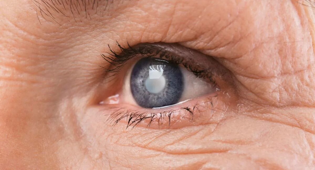 Заболевания и нарушения органов зрения. Инфекционные заболевания глаз. Катаракта глаза симптомы причины. Катаракта глаза симптомы. Катаракта симптомы у женщин.