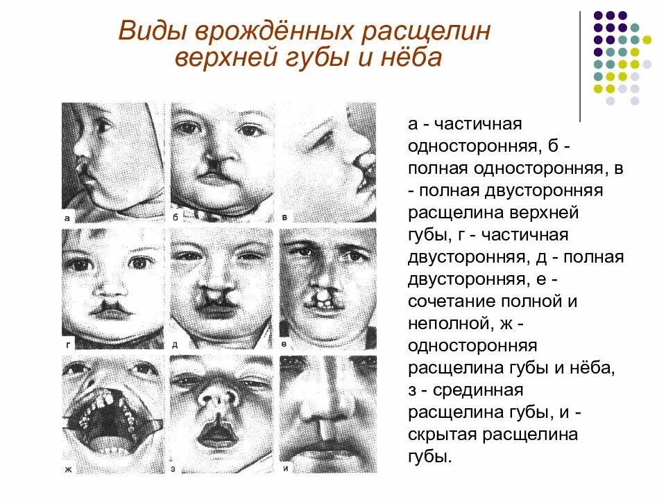 Ринолалия расщелина верхнего. Расщелины губы при ринолалии. Расщелина твёрдого нёба синдром. Сквозная расщелина верхней губы и неба.