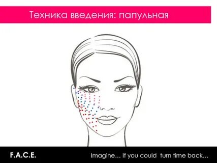 Схема мезотерапии