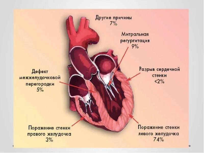 Инфаркт миокарда межжелудочковой перегородки. Разрыв сердечной мышцы. Инфаркт миокарда межжелудочковой перегородки. Морфология острого, рецидивирующего, повторного инфаркта миокарда. Стенки миокарда на эхокг.