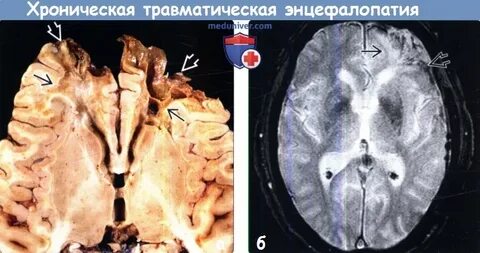 Энцефалопатия на мрт мозга