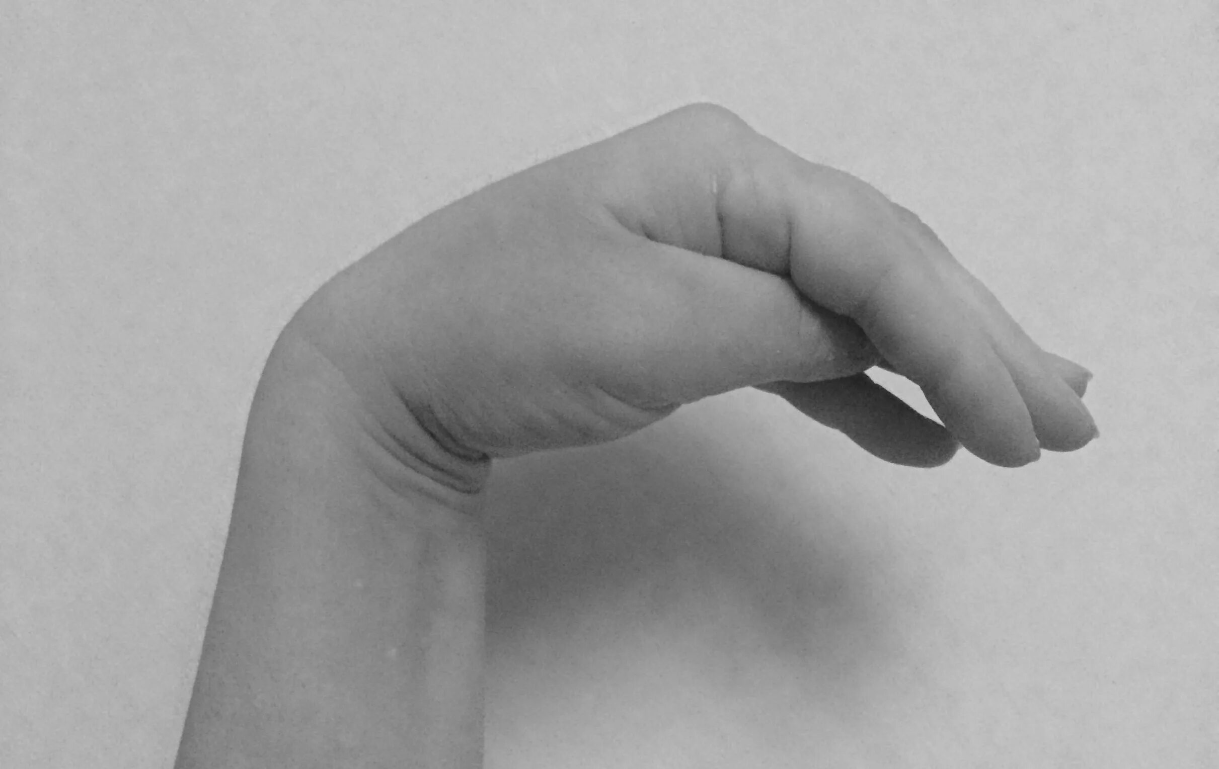 Классический наружно-внутренний поворот плода на ножку. Ручное акушерское пособие при головном предлежании. Пальцы акушера. Спазмофилия рука акушера. Повреждение лучевого и локтевого нерва.