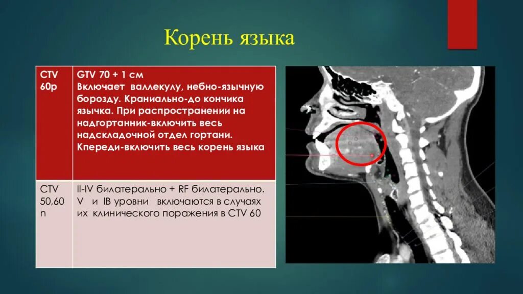 Корень языка анатомия на кт. Ротоглотка кт анатомия. Злокачественные новообразования ротоглотки. Опухоль корня языка кт.