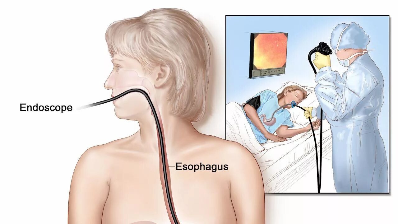 Скопия пищевода. Гастроскопия (ЭГДС, ФГДС). Эндоскопия пищевода ФГДС. Эзофагогастродуоденоскопия схема.