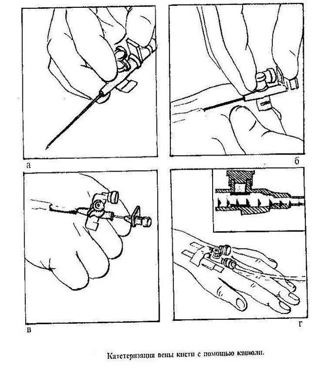 Алгоритм сбора системы для внутривенного капельного вливания. Алгоритм nru. Техника заполнения системы для внутривенного капельного вливания. Алгоритм сбора системы для внутривенного капельного вливания. Техника заполнения системы для внутривенного капельного вливания.
