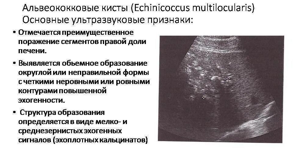 Неоднородное изменение печени. Альвеококковая киста печени на УЗИ. Альвеококковые кисты в печени. Эхинококковая киста почки УЗИ заключение.