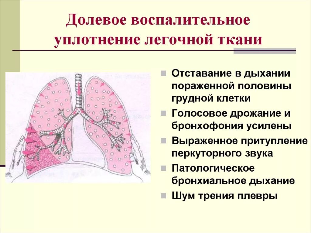 Синдром долевого уплотнения легочной ткани. Синдром уплотнения легочной ткани рентген. Синдром долевого уплотнения легочной ткани рентген. Синдром воспалительного уплотнения легочной ткани пропедевтика. Звук в легких при дыхании