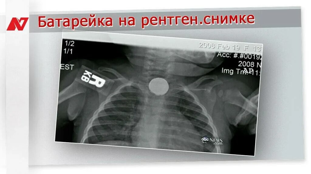 Ребенок проглотил батарейку. Инородное тело батарейка. ребёнок проглотил батарейку таблетку.