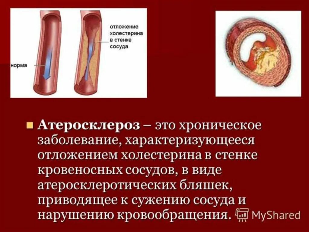 Атеросклеротическое поражение сосудов.